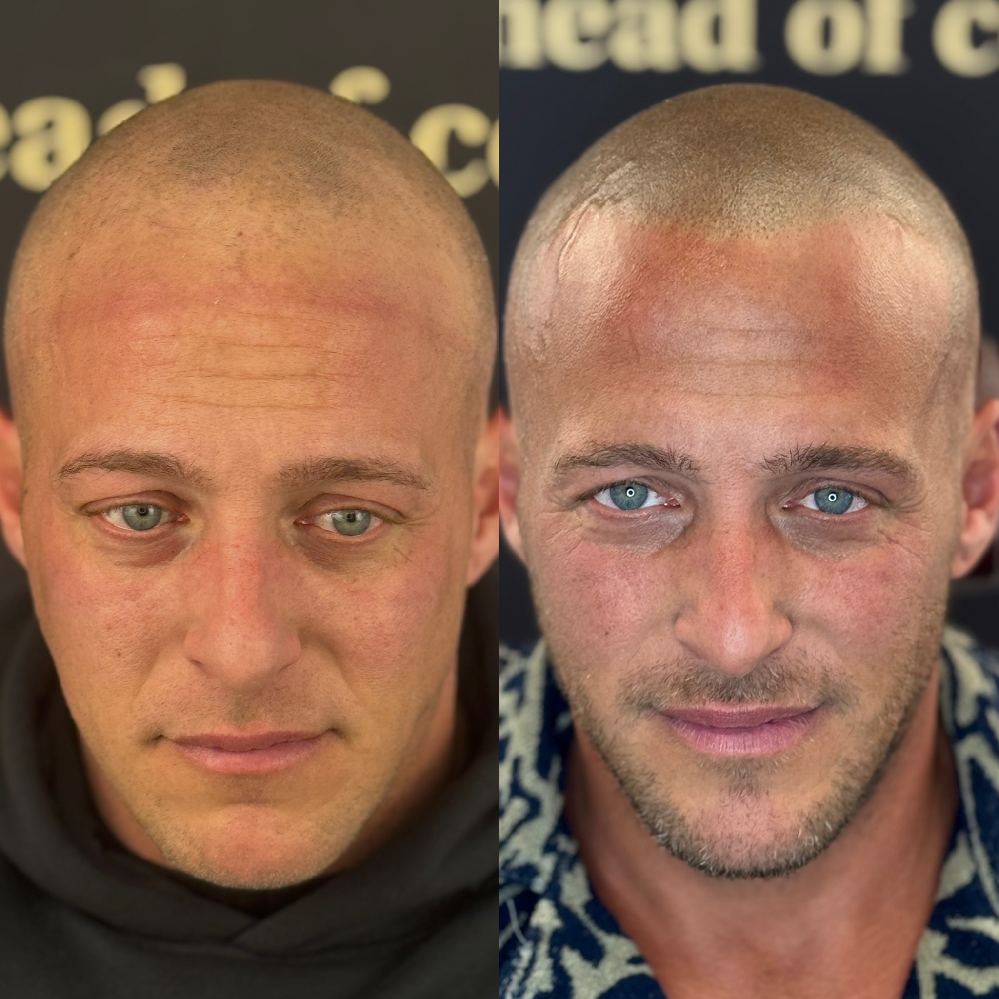 Mikrohaarpigmentierung Heerlen – BALD Studio Mikrohaarpigmentierung vorher nachher Ergebnis bei BALD Studio in Heerlen