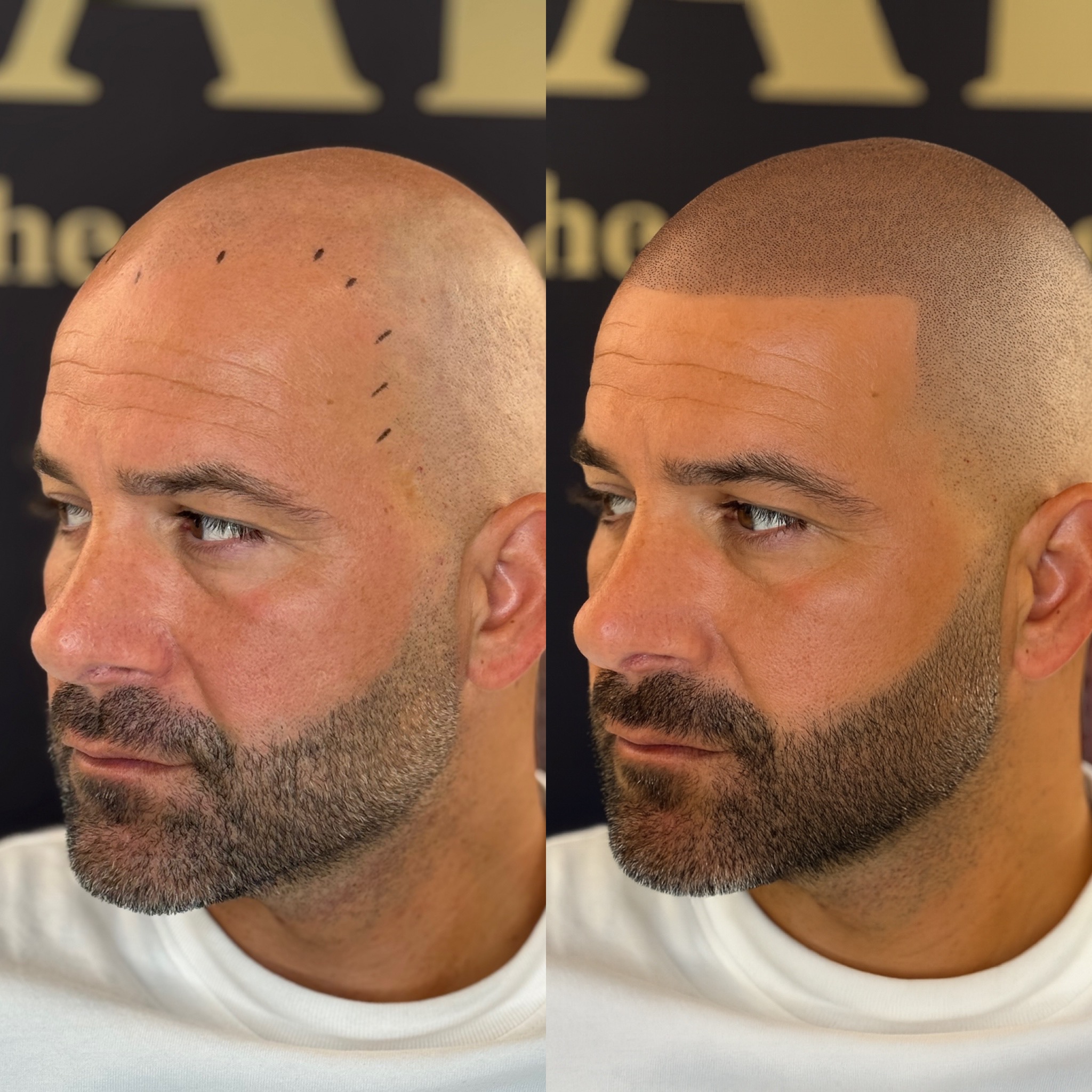 BALD Micro Hair Pigmentierung Ergebnis