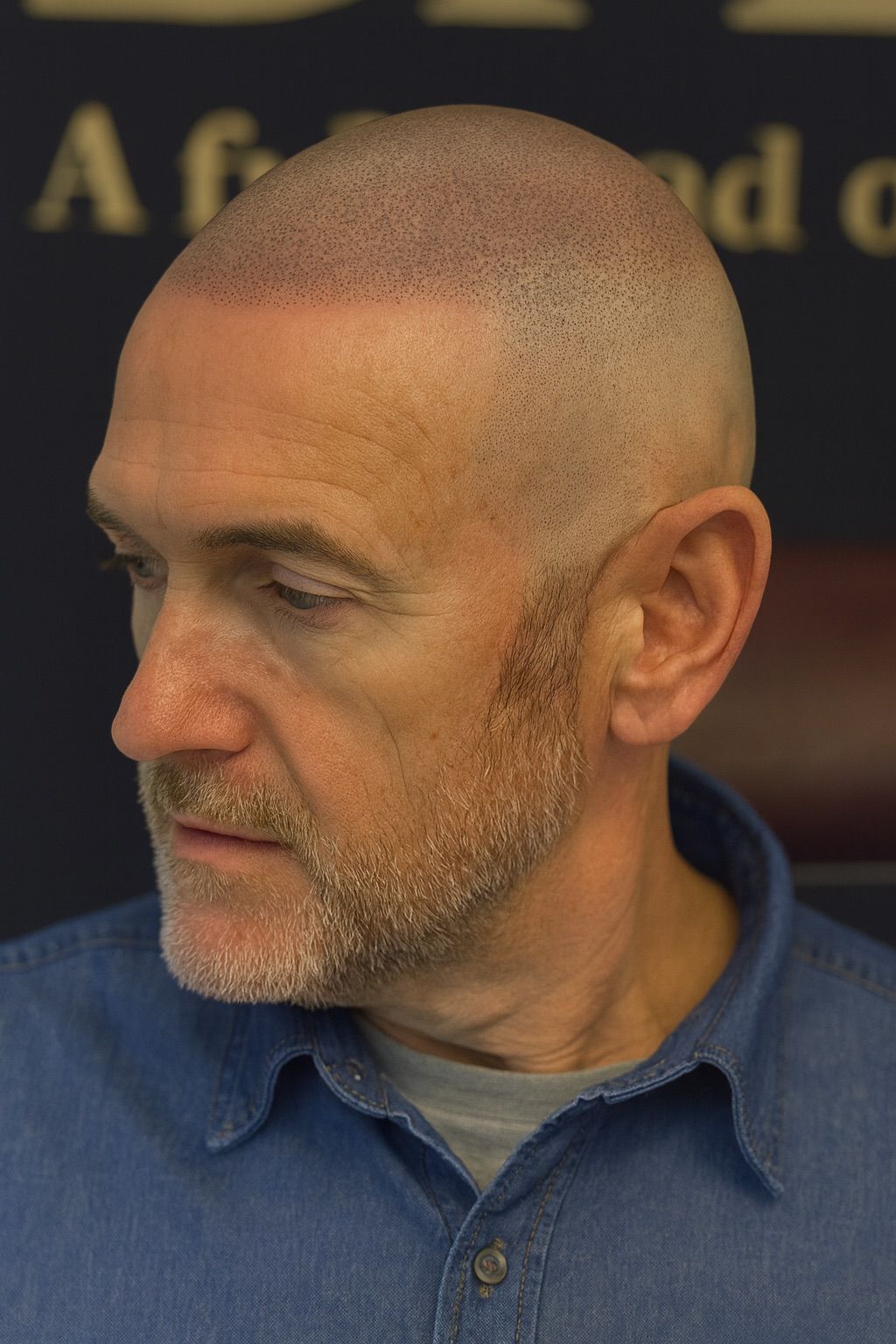 BALD Micro Hair Pigmentierung Ergebnis