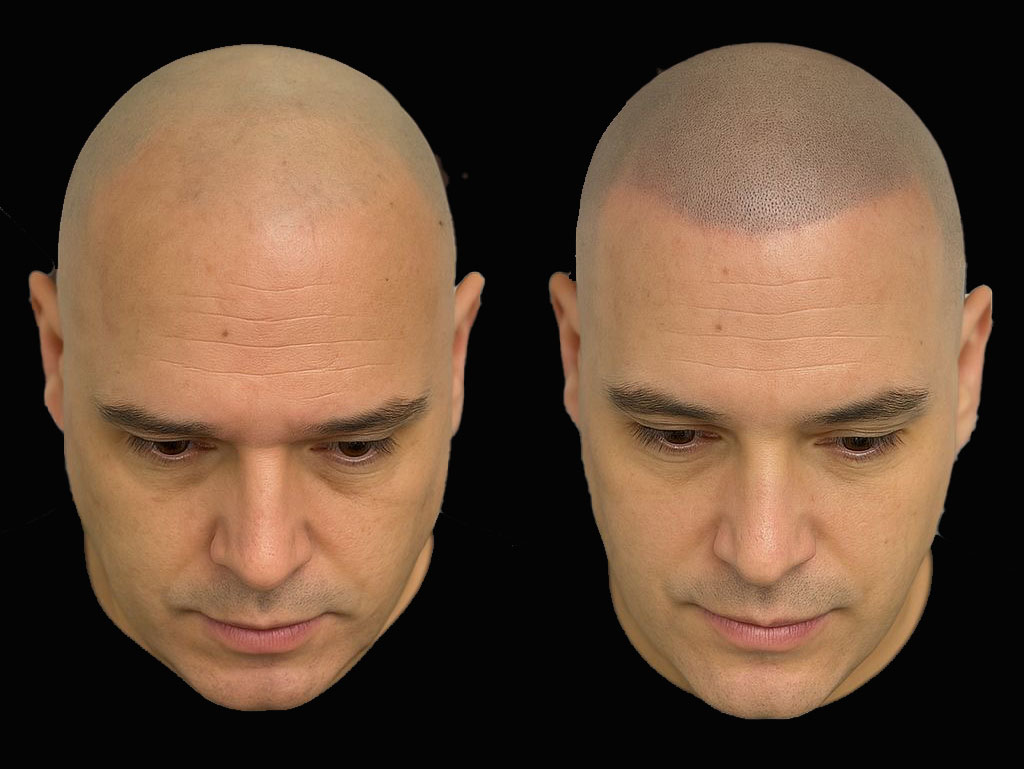 BALD Micro Haar Pigmentatie Resultaat