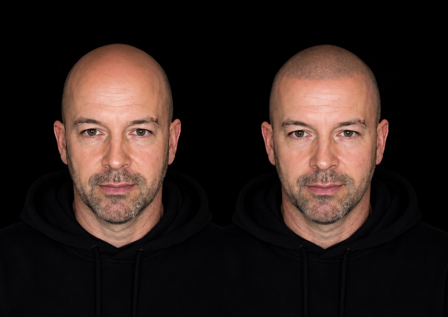 BALD Micro Hair Pigmentierung Ergebnis