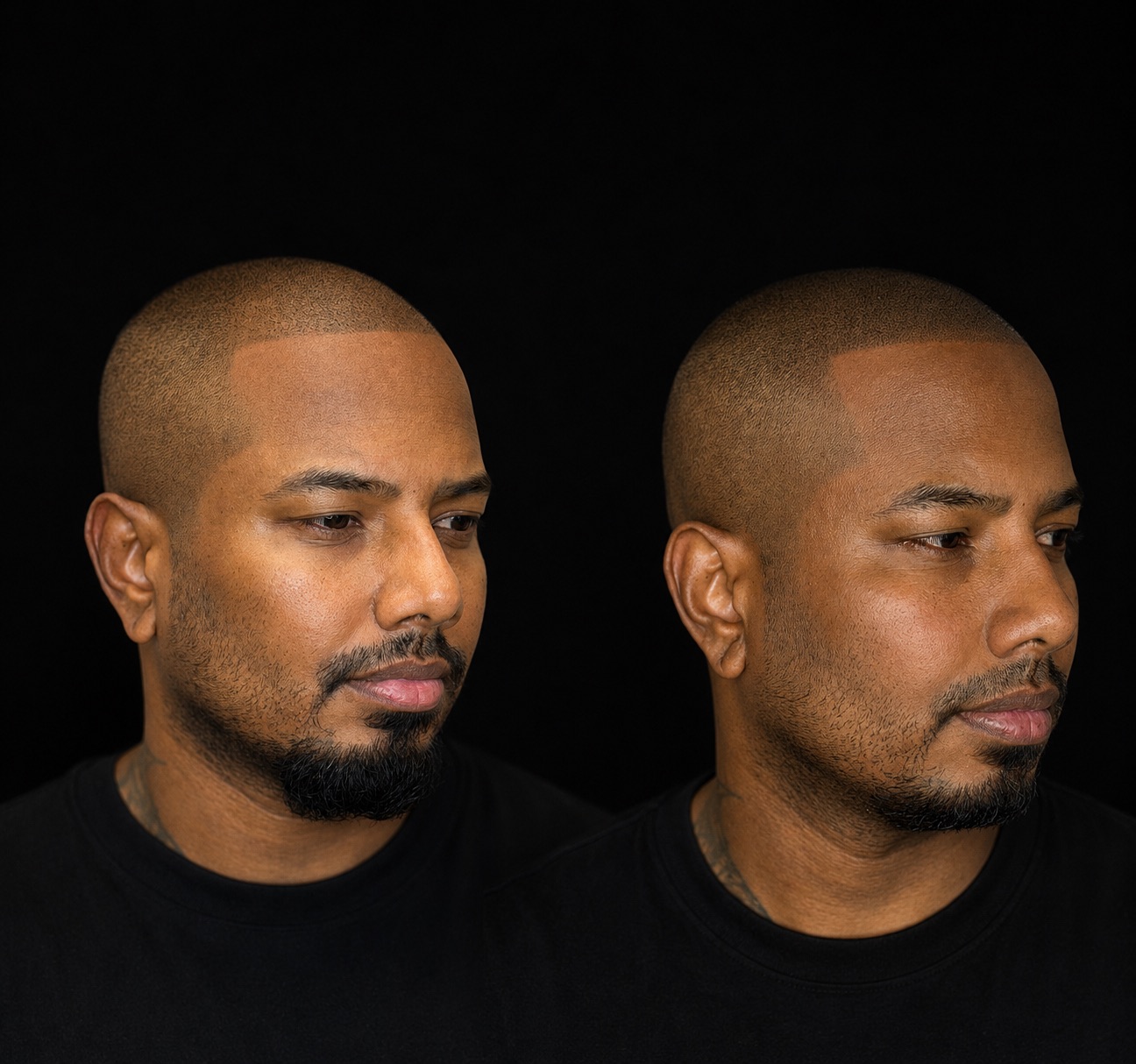 BALD Micro Hair Pigmentierung Ergebnis