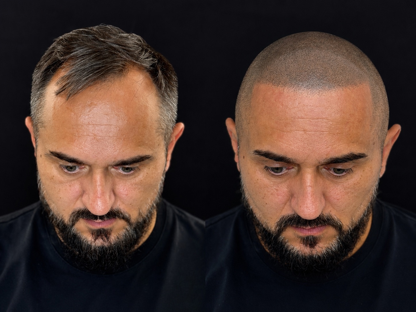 BALD Micro Hair Pigmentierung Ergebnis