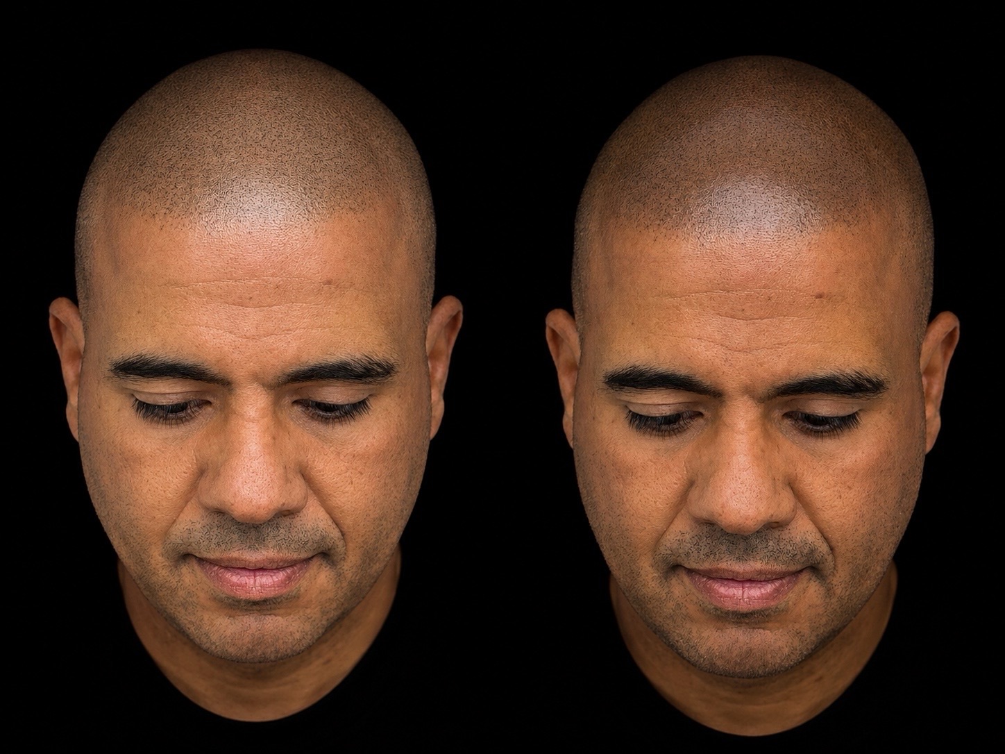 BALD Micro Hair Pigmentierung Ergebnis
