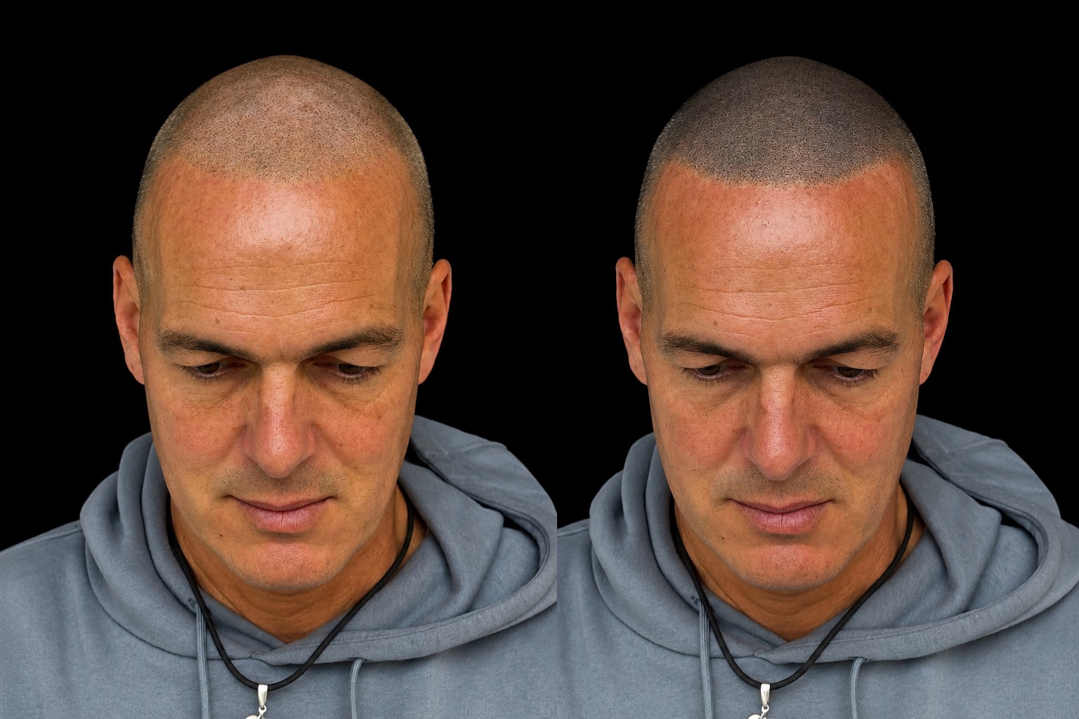 BALD Micro Hair Pigmentierung Ergebnis