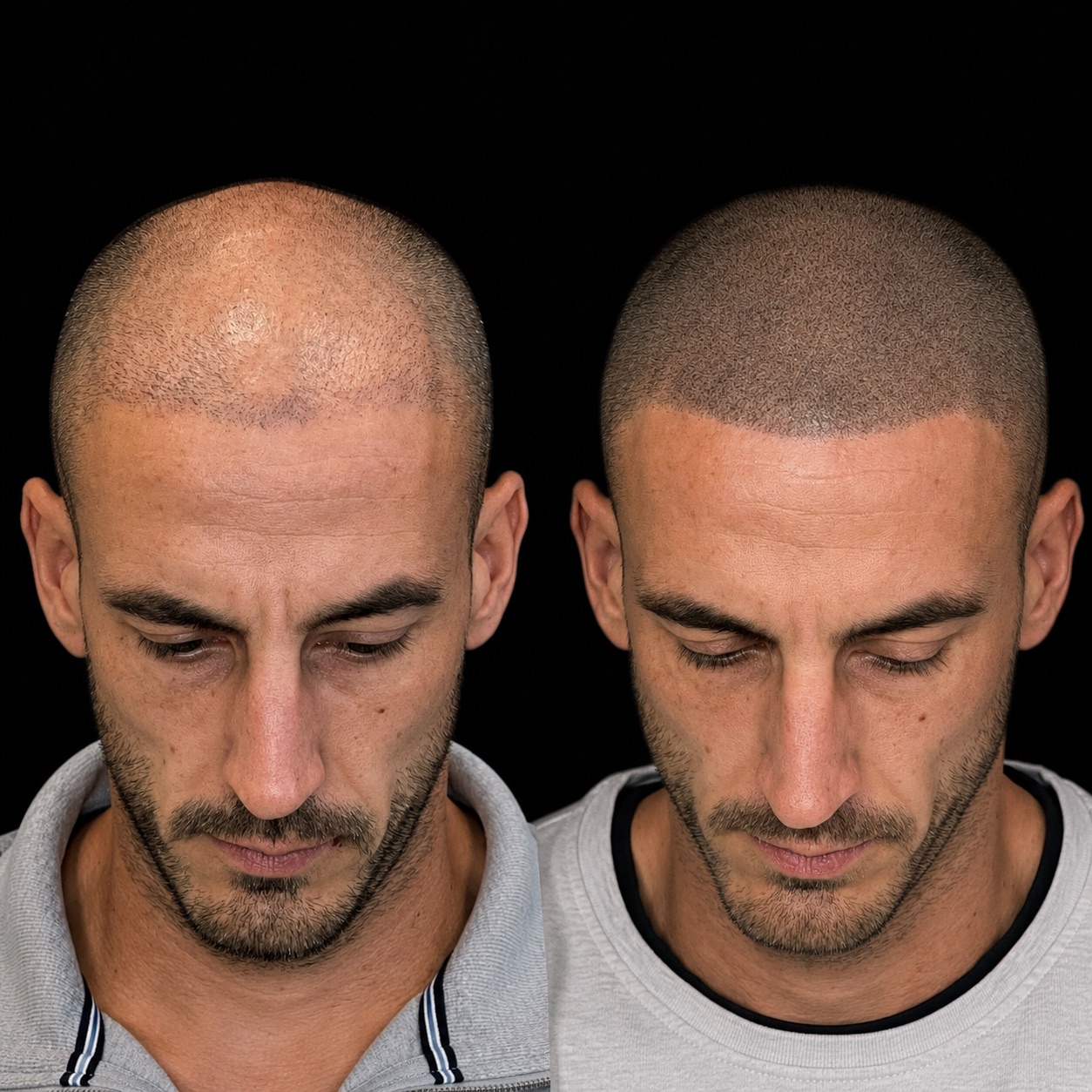 BALD Micro Hair Pigmentierung Ergebnis