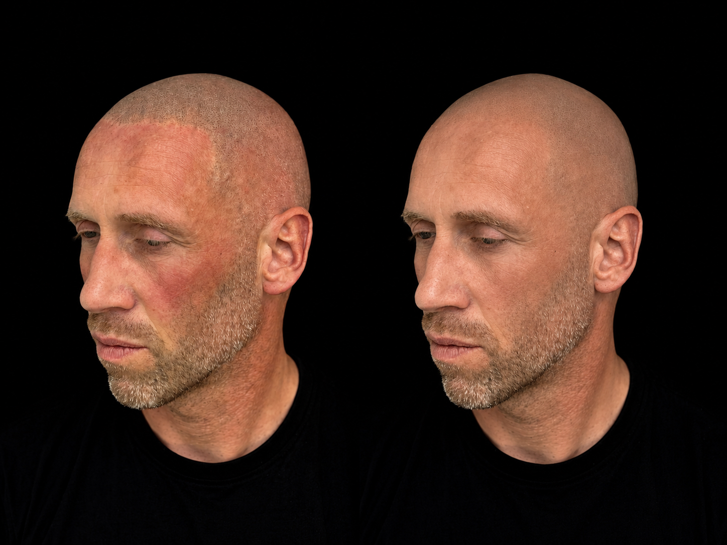 BALD Micro Hair Pigmentierung Ergebnis