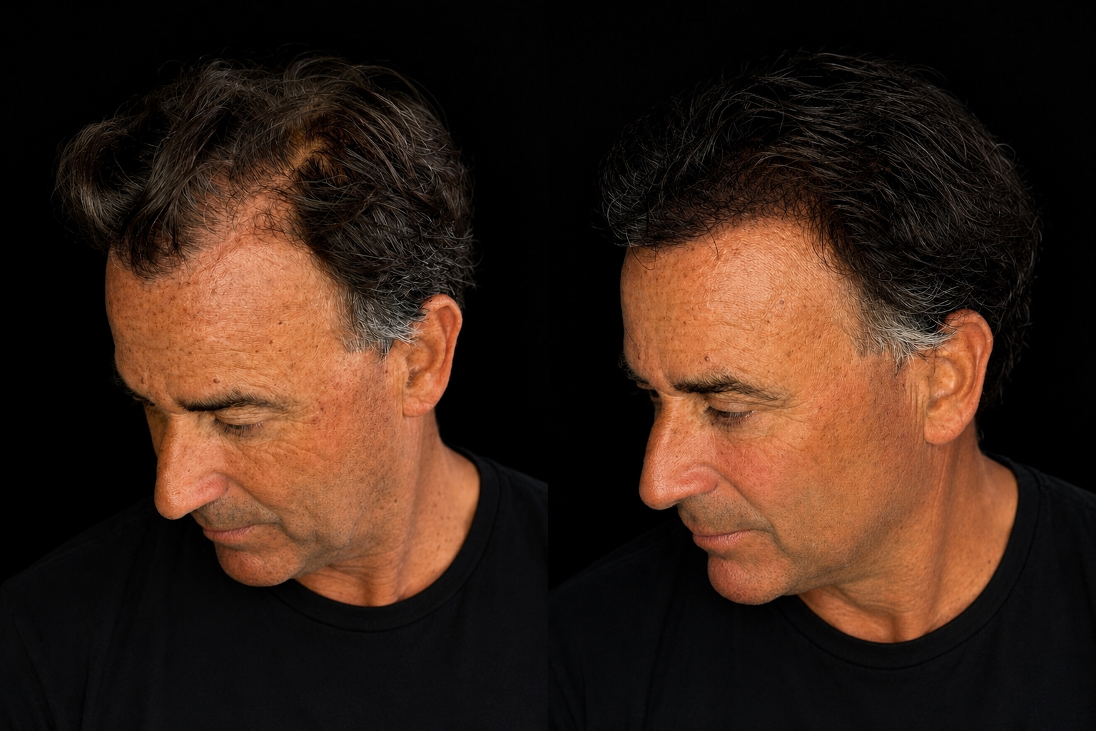 BALD Micro Hair Pigmentierung Ergebnis