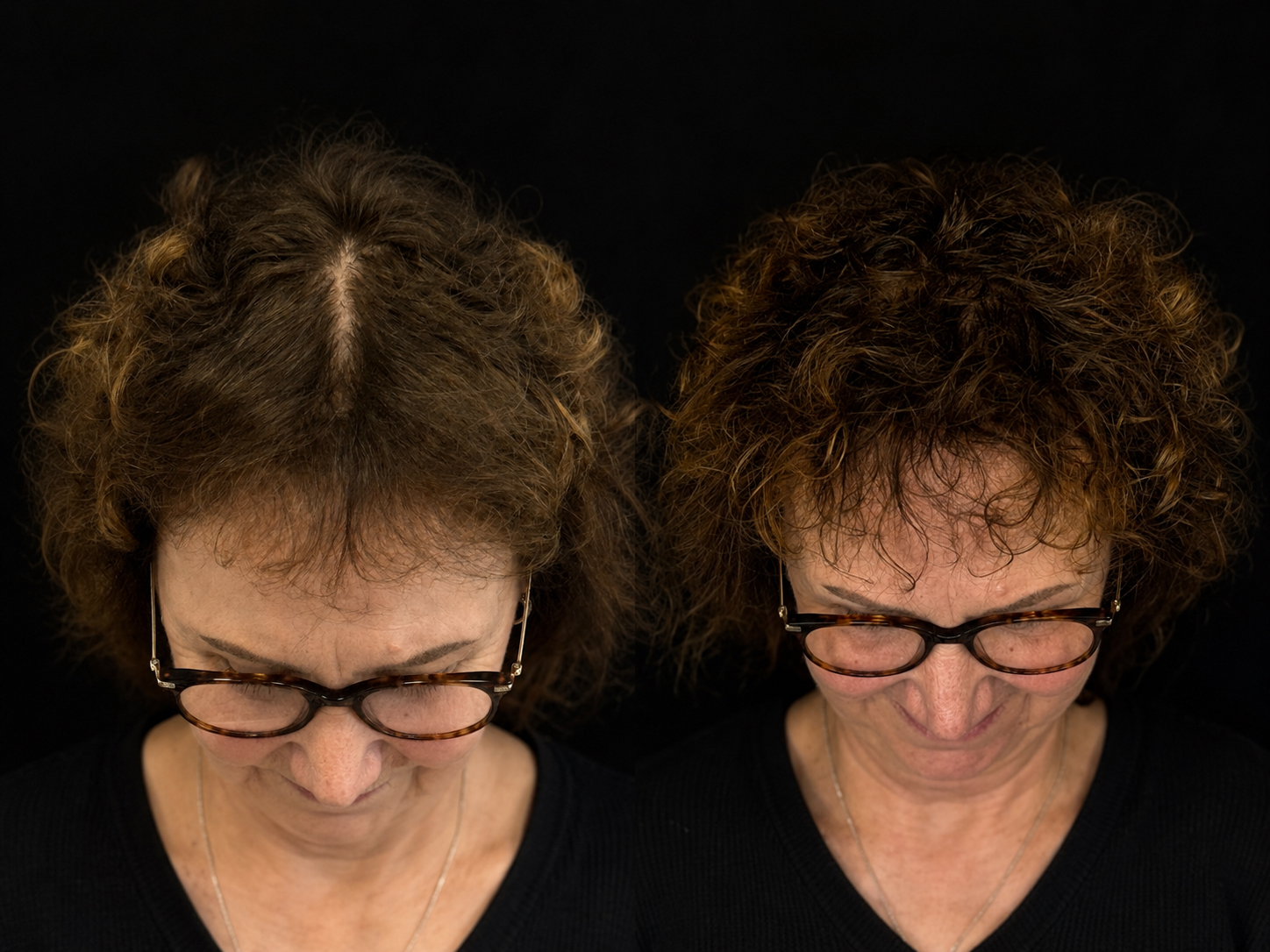 BALD Micro Hair Pigmentierung Ergebnis