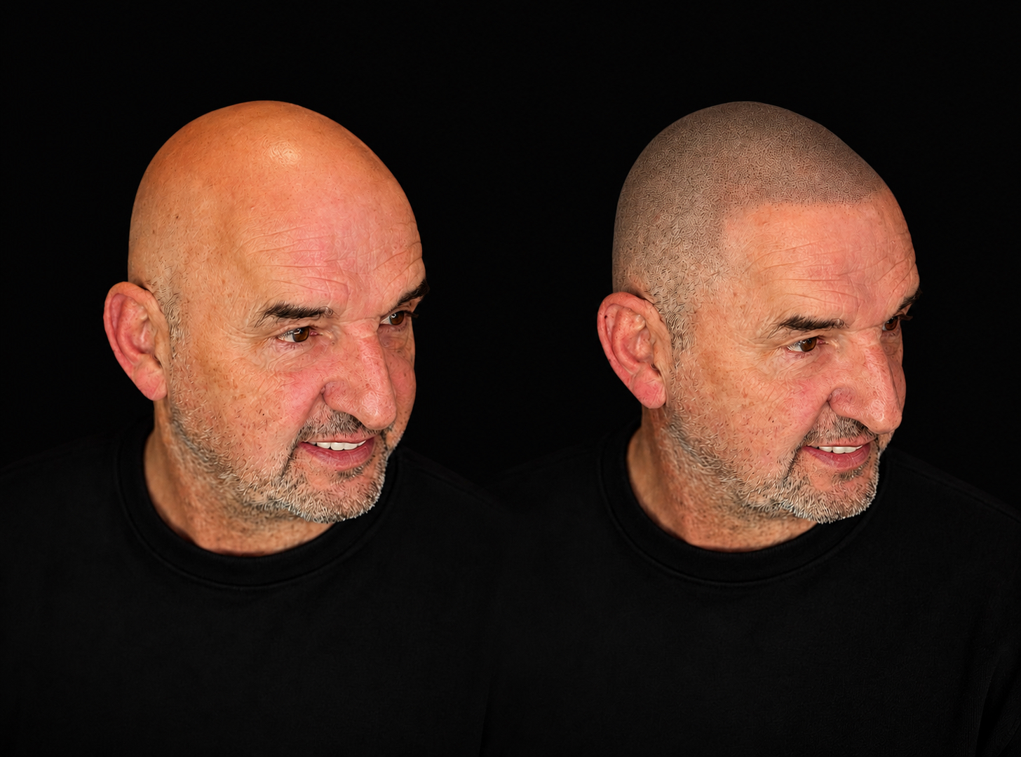 BALD Micro Hair Pigmentierung Ergebnis