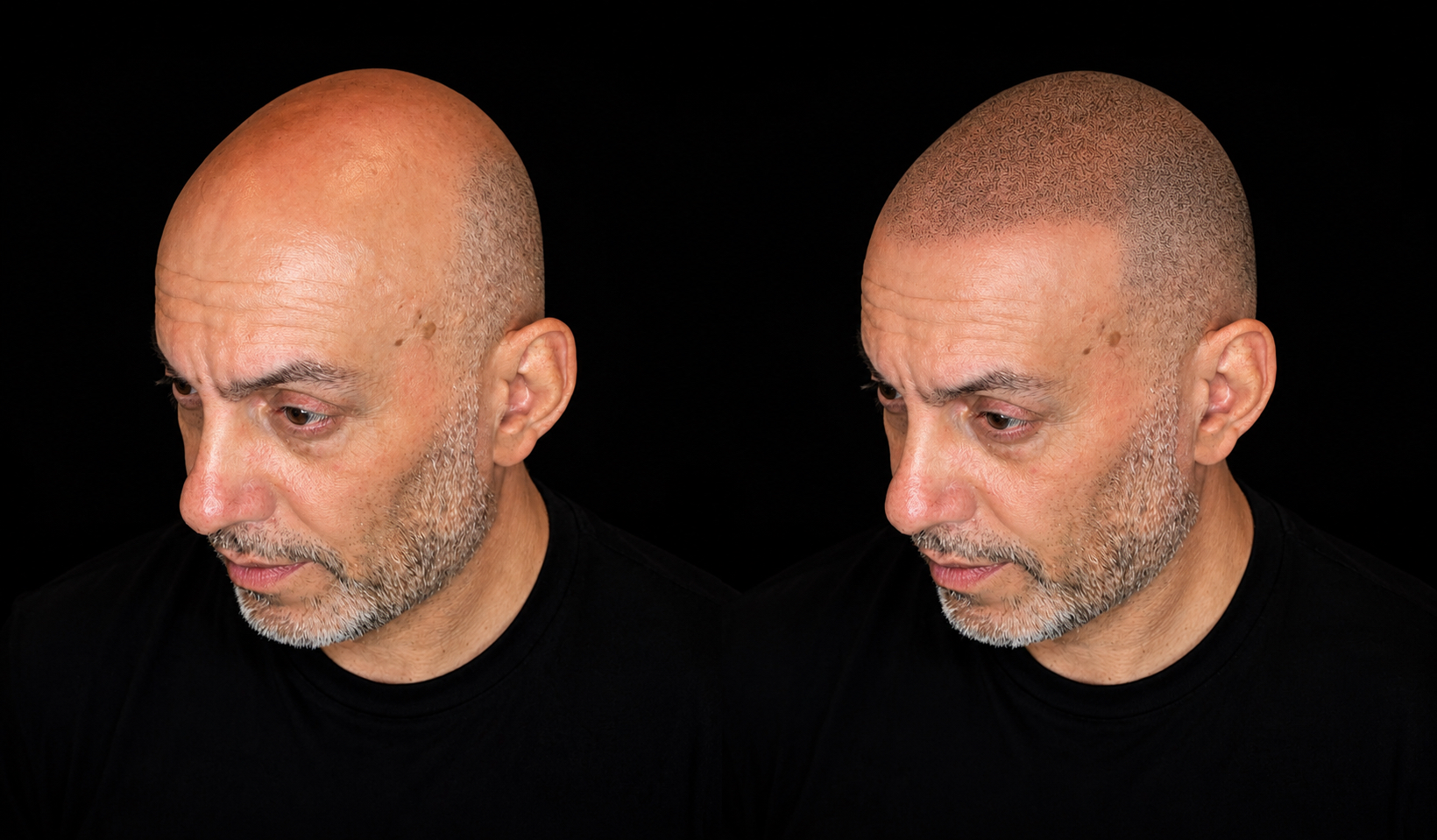 BALD Micro Hair Pigmentierung Ergebnis