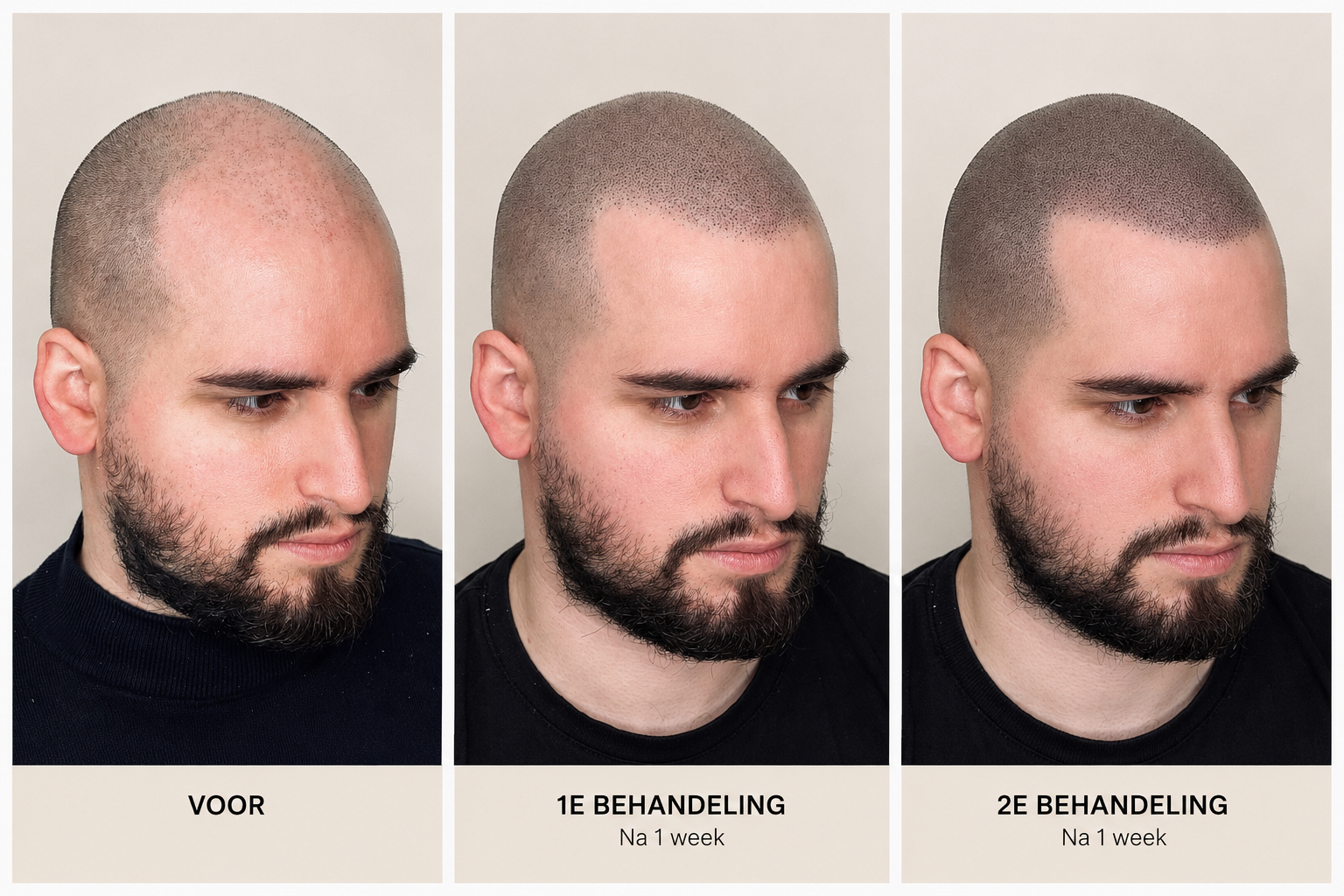 BALD Micro Haar Pigmentatie Resultaat
