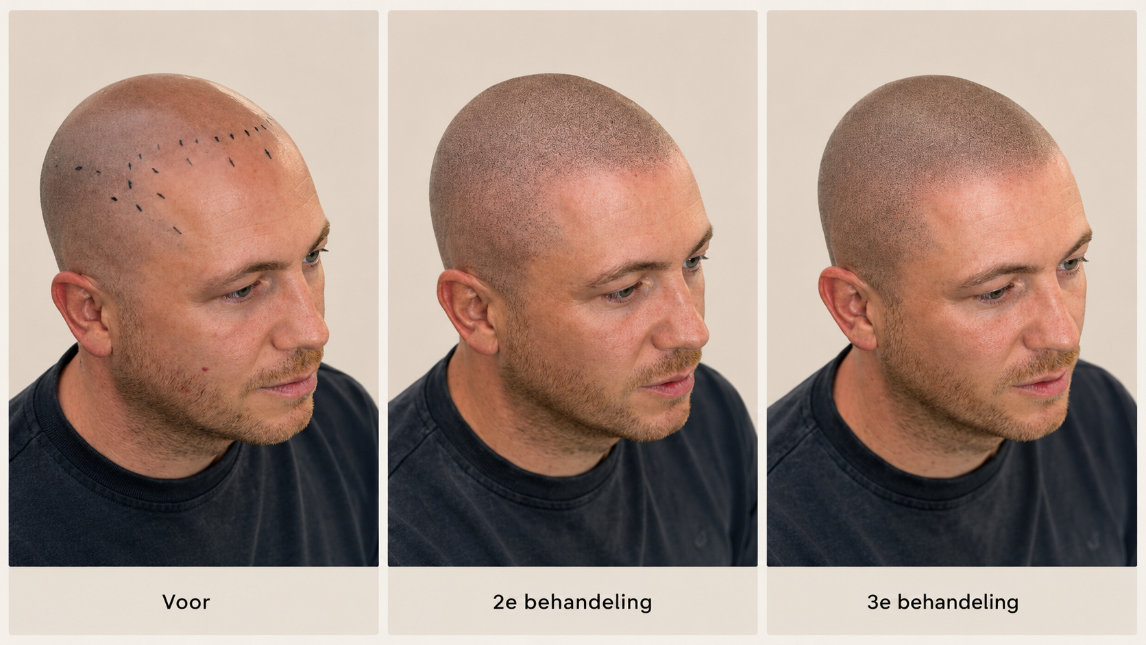 BALD Micro Haar Pigmentatie Resultaat