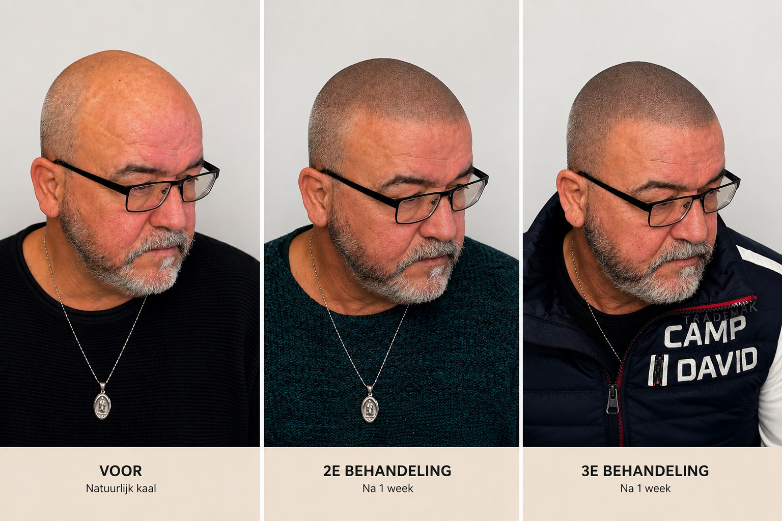 BALD Micro Haar Pigmentatie Resultaat