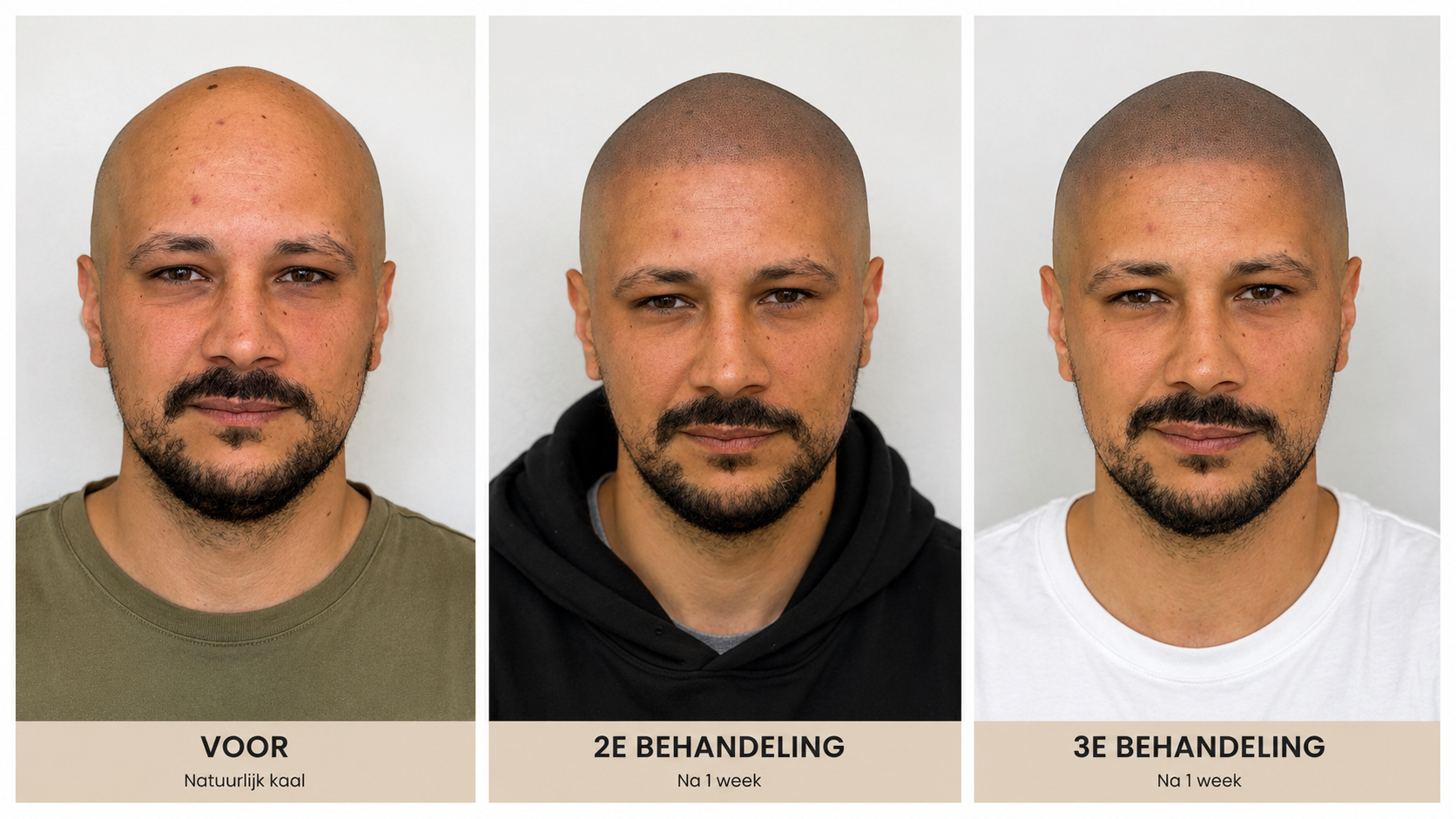 BALD Micro Haar Pigmentatie Resultaat