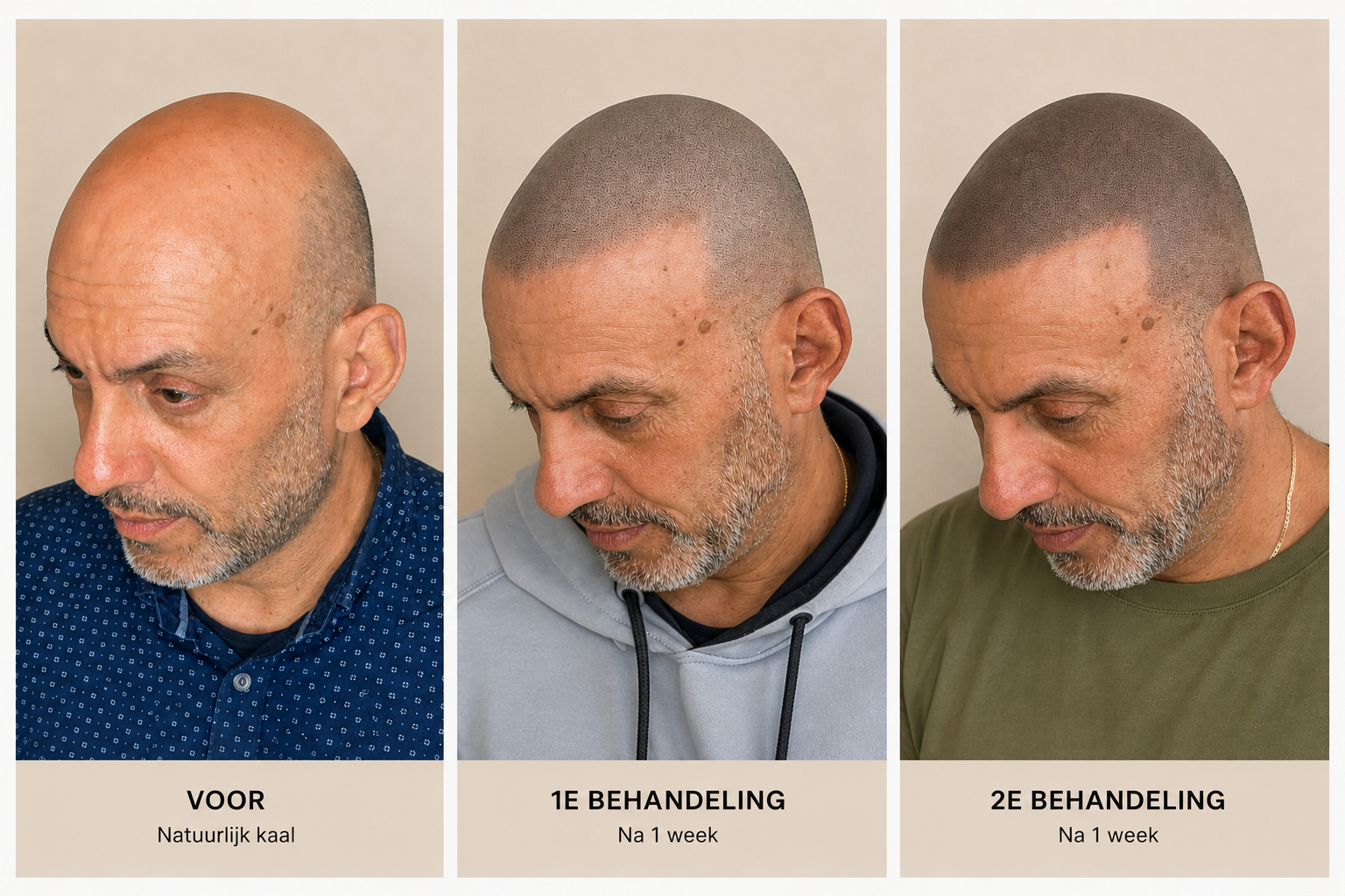 BALD Micro Haar Pigmentatie Resultaat