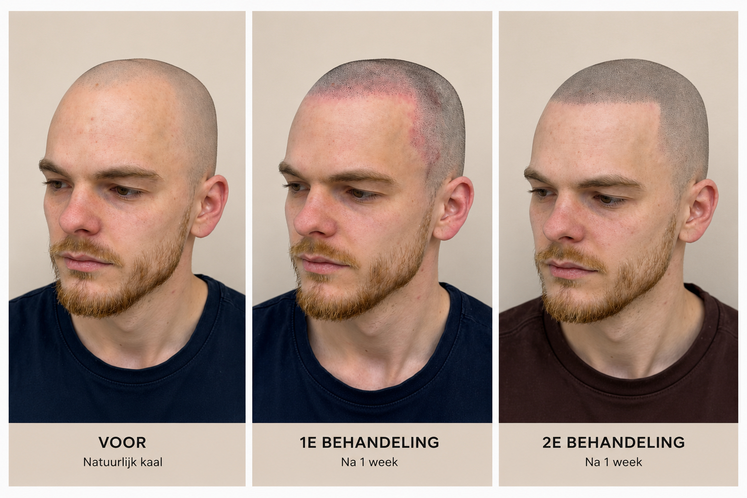 BALD Micro Haar Pigmentatie Resultaat