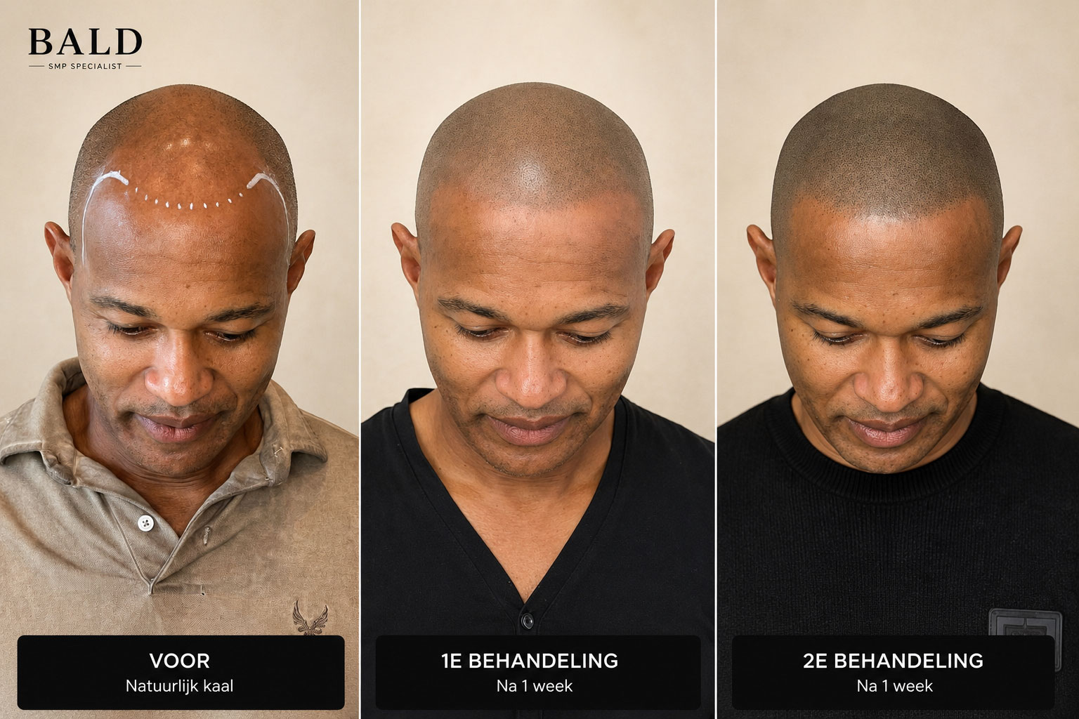 BALD Micro Haar Pigmentatie Resultaat